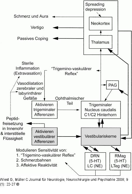 Migräne-assoziierter Schwindel