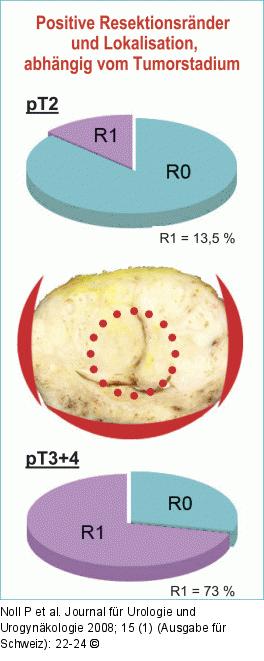 Tumorpositive Resektionsränder