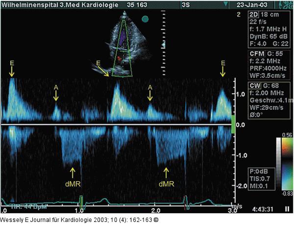 Transmitrale CW-Dopplerregistrierung
