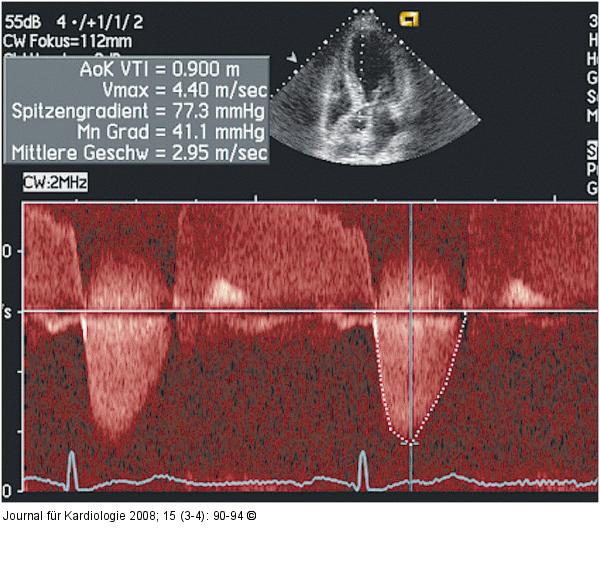 Aortenstenose
