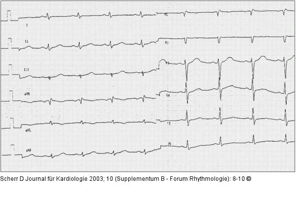 Brugada-Syndrom - EKG