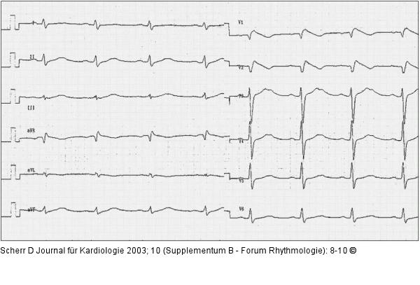 Brugada-Syndrom - Ajmalin-Test