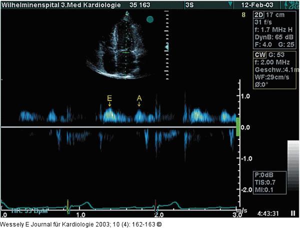 Transmitrales CW-Dopplerregistrierung