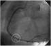 Abb. 3: Mobiler Thrombus in der RCA bei NSTEMI