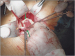 Abb. 2: Aneurysma
