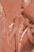 Abb. 6: Prothese - A. mensenterica inferior 