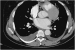 Abb. 8: Aorta-Dissektionsmembran