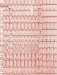 Abb. 13: AVNRT