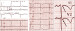 Abb. 17: QRS-Komplex