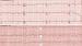 Abb. 21: QT-Intervall
