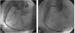 Aktuelles Bild - Abb. 4a: Mobiler Thrombus der RCA bei NSTEMI