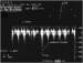 Abb. 3: LVOT