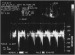 Abb. 4: LVOT
