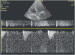 Aktuelles Bild - Abb. 11: LVOT-VTI