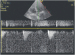 Abb. 13: LVOT-VTI