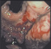 Abb. 3: Gastritis