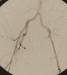 Aktuelles Bild - Abb. 1: Morbus embolicus
