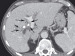 Abb. 1a: Hypodenser Tumor