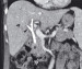 Abb. 1b: Bilaterale Gallengangstents