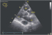 Abb. 1: Sinus coronarius