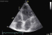 Abb. 2: Sinus coronarius
