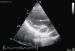 Abb. 3: Sinus coronarius