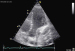 Abb. 4: Sinus coronarius