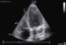 Abb. 5: Sinus coronarius