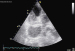 Abb. 6: Sinus coronarius