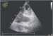 Abb. 7: Sinus coronarius