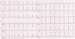 Aktuelles Bild - Abb. 1: EKG
