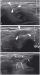 Abb. 11a-b: Nervus cutaneus femoris lateralis