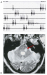 Abb. 8a-b: Fazialis-Myokymie 