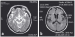 Aktuelles Bild - Abb. 1: Steele-Richardson-Olszewski-Syndrom
