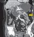 Aktuelles Bild - Abb. 5: CT-Cholezystis - Ileus