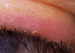 Aktuelles Bild - Abb. 8: Blepharitis