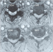 Abb. 2: Spinalkanal