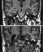 Abb. 1: Alzheimer-Demenz