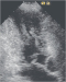 Abb. 2: Hypertrophe CMP