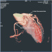 Aktuelles Bild - Abb. 2: Arteria coronaria
