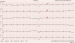 Abb. 1: 12-Kanal-EKG