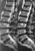 Abb. 1b: Spinalkanalstenose