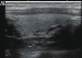 Abb. 1: Schilddrüsensonographie