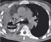 Aktuelles Bild - Abb. 2b: Gastro-bronchiale Fistel