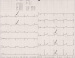 Abb. 1: EKG