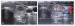 Aktuelles Bild - Abb. 12a-b: Karzinom
