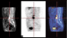 Abb. 2: Ossäre Metastase