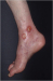 Abb. 3: Ulcus cruris arteriosum
