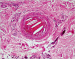 Abb. 3: Cholesterinkristallembolie