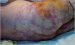 Abb. 6: Livedo reticularis